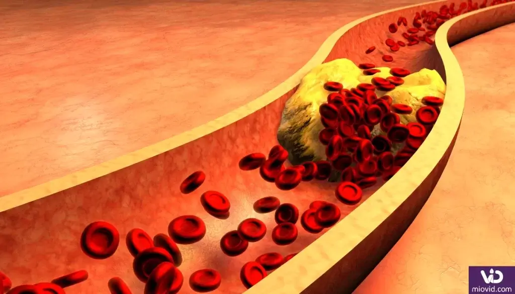 La calcificación vascular está influenciada por varios factores, como el envejecimiento, la diabetes, la hipertensión, la inflamación y otros